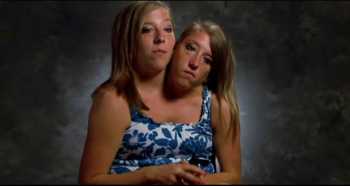 Conjoined twins Abby and Brittany Hensel biography, age, husband, children, separated